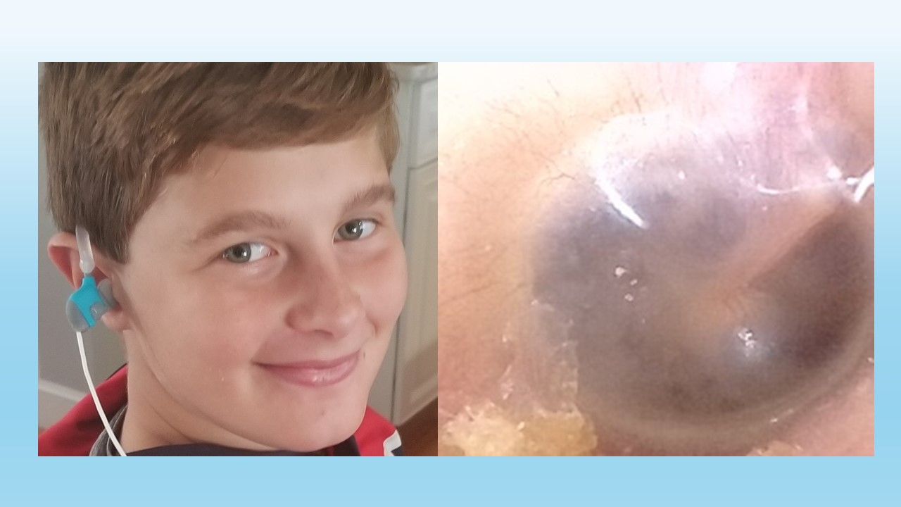 Braeden using Zipline device with actual eardrum image